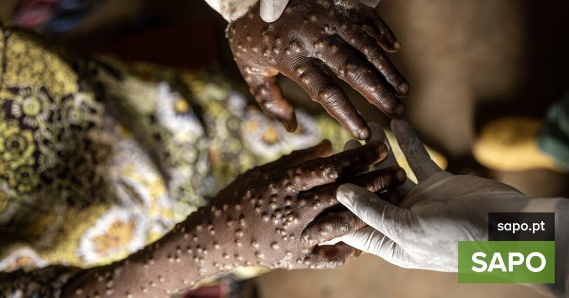 África regista 132.954 casos de mpox e 1.761 mortes desde o início de 2024