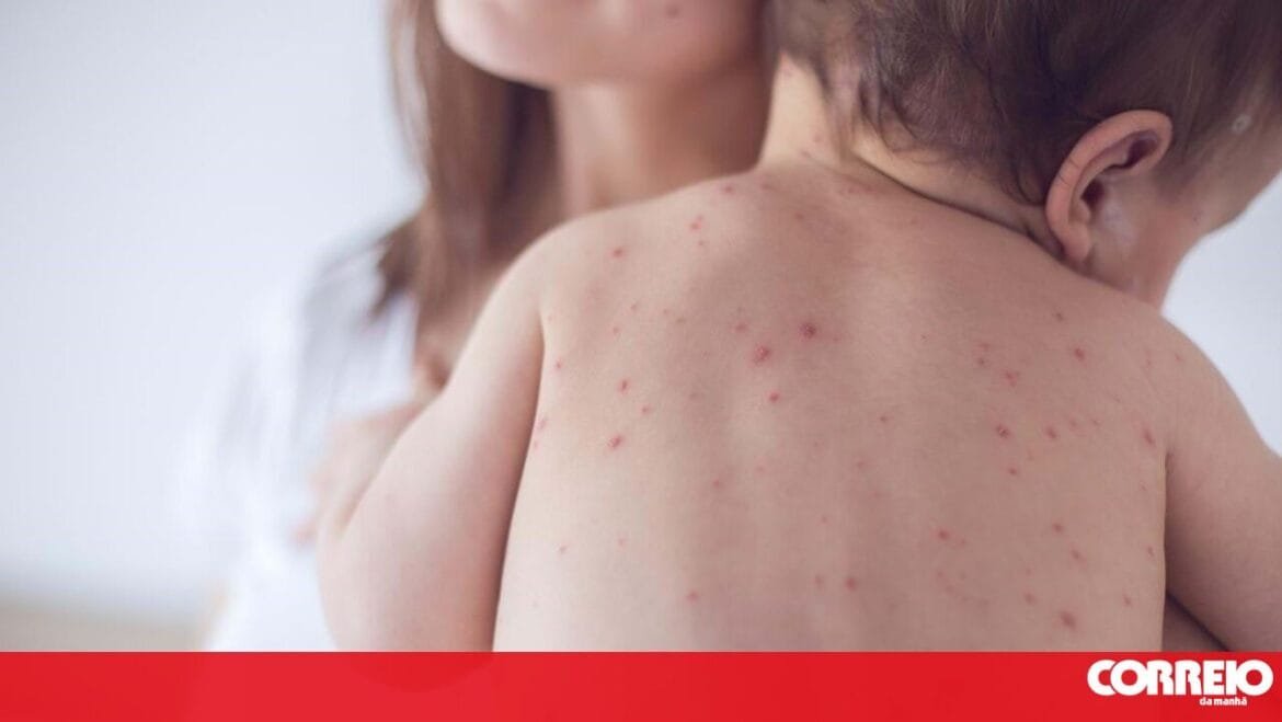 Aumento de casos de sarampo na Europa deixam alerta para as férias