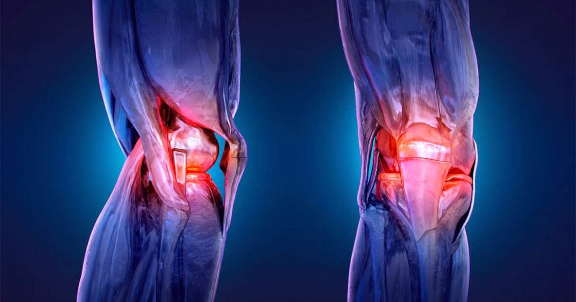 O que os seus joelhos ‘crepitantes’  estão a tentar dizer-lhe